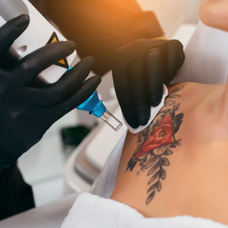 Tattooentfernung